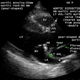 inferior wall hypokinesis treatment.